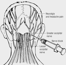 Occipital Nerve Block
