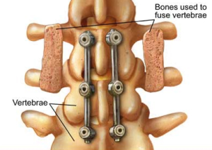 Failed Back Surgery