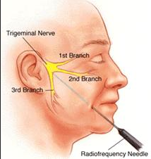 Trigeminal Neuralgia Radiofrequency