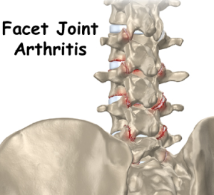 https://www.nipmmi.com/wp-content/uploads/2013/06/facet-arthritis-300x274.png