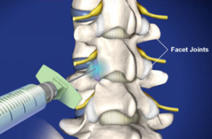 Facet Joint Injection