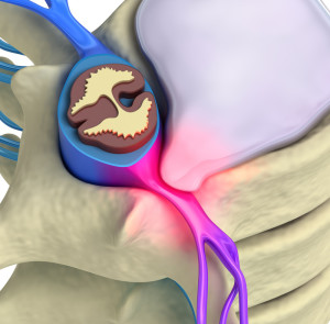 Sciatica Treatment NIPM