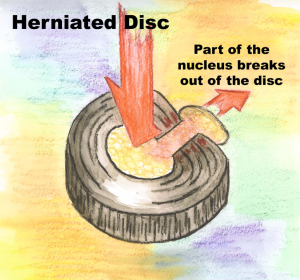 Herniated Disc